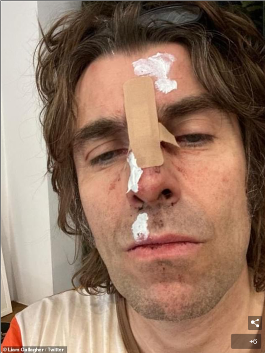 Liam Gallagher suffers facial injury after falling out of helicopter.png